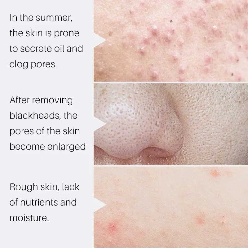 سيروم حمض الساليسيليك لتضييق ا - مراجعة Salicylic Acid Blackhead Remover وسعره